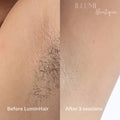 LuminHair Laser Removal Device - Illumi Boutique