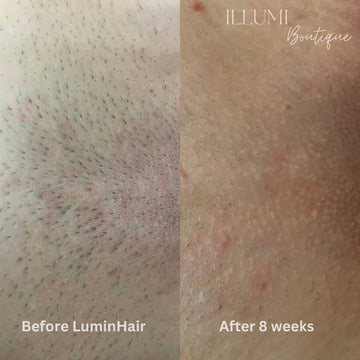 LuminHair Laser Removal Device - Illumi Boutique