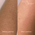 LumiTrim Hair removal device - Illumi Boutique